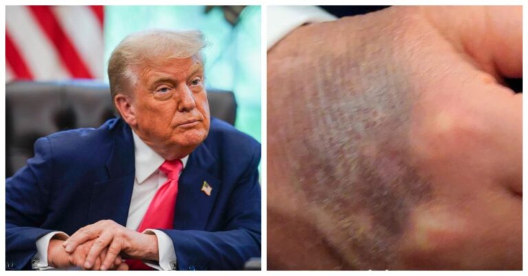 Bruise on Donald Trump's Hand Sparks 'Game of Thrones' Comparison — "He's Got Greyscale!"