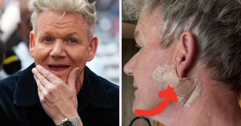 Gordon Ramsay Just Shared Photos After His Skin Cancer Surgery
